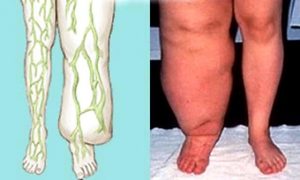 mengenal filariasis